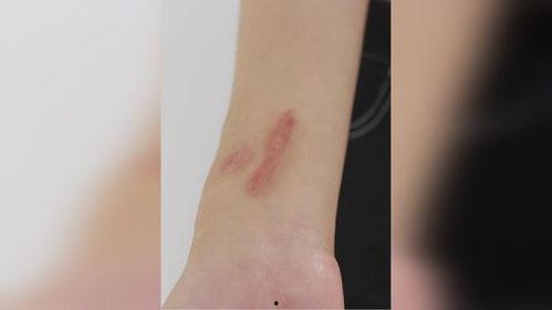 国产祛疤,匠心独运，美丽不留痕